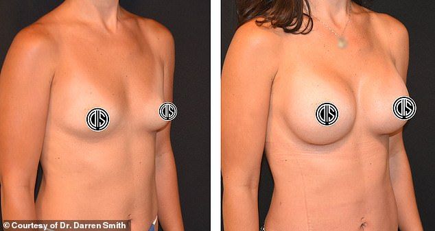Before and after: A patient in their 30s with silicone breast implants sized 305cc with a moderate plus profile and 'love handle' liposuction
