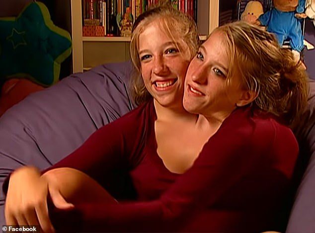 The siblings, 35, from Minnesota , are one of only a few sets of dicephalic twins in history