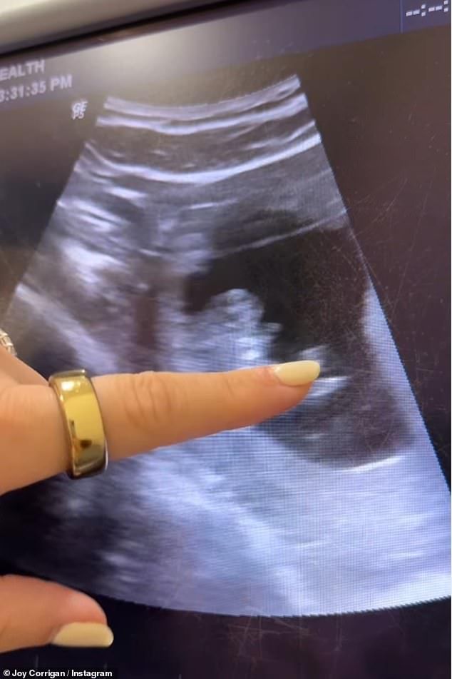 When the ultrasound technician showed the happy couple the sonogram, Todd chirped: 'Wow, there it is!' only to be told: 'No, that's two.'