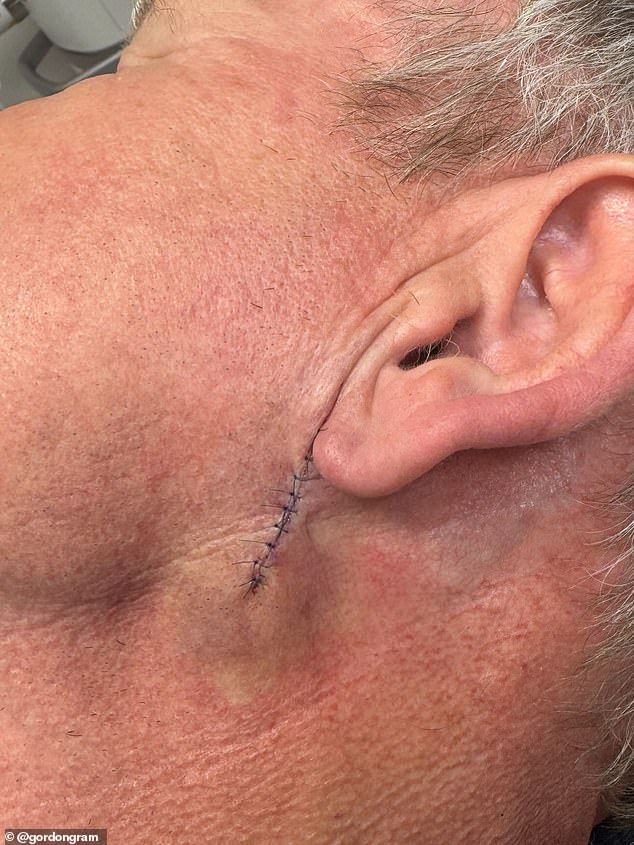 Despite his bumper 24,691-a-day pay check and recent skin cancer scare (his scar pictured), Gordon doesn't look like he is planning to slow down anytime soon as his former series Hell's Kitchen is set for a major reboot