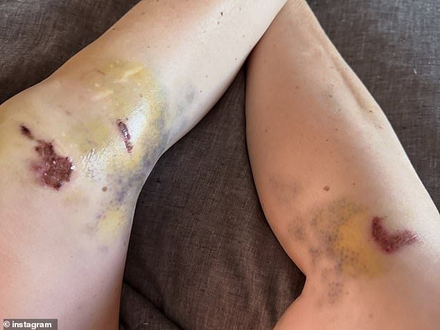 She also revealed the impact of the crash on her legs, which were covered in yellow and blue bruises